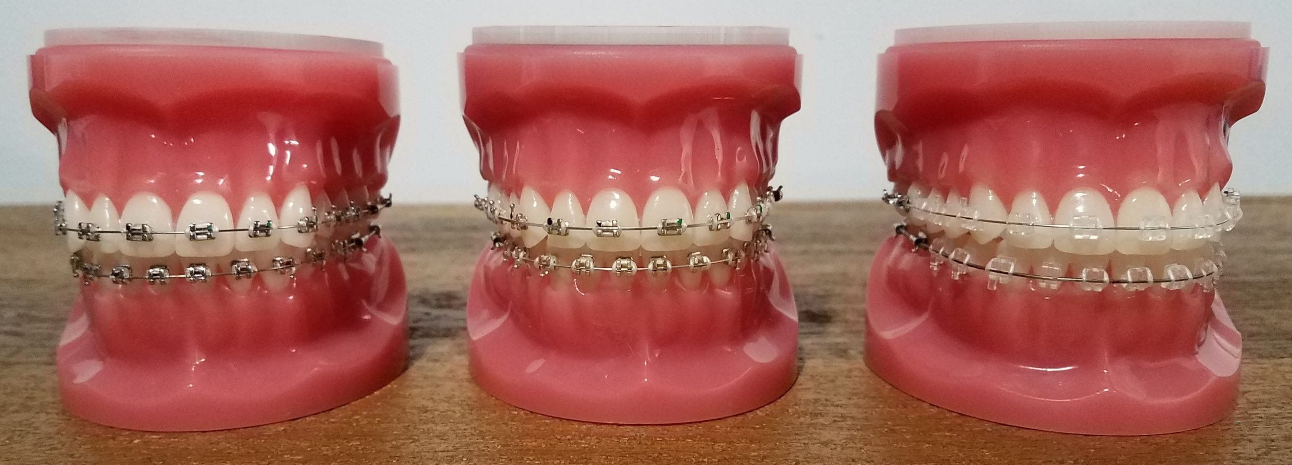 Braces – Kanas Orthodontics